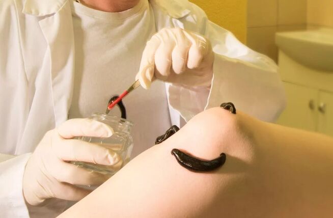 Hirudotherapy for varicose veins
